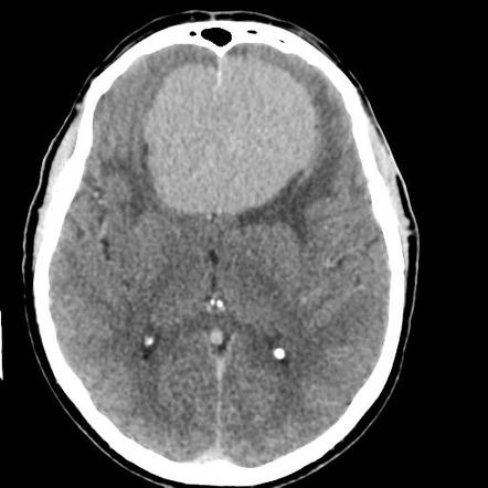 Olfactory groove meningioma - huge | Image | Radiopaedia.org