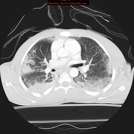 Pulmonary Contusion | Radiology Reference Article | Radiopaedia.org