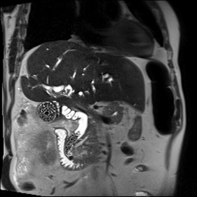 Choledocholithiasis Radiology Reference Article