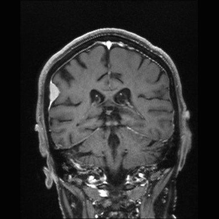 Dural Metastases | Radiology Reference Article | Radiopaedia.org