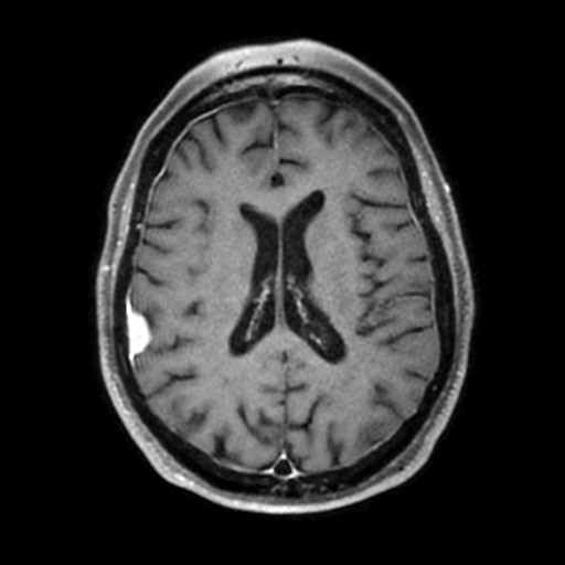 Dural Metastases Mimicking Meningiomas | Image | Radiopaedia.org