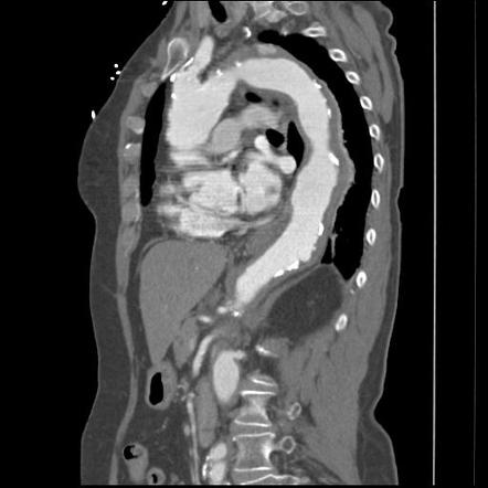 Penetrating atherosclerotic ulcer | Radiology Reference Article ...