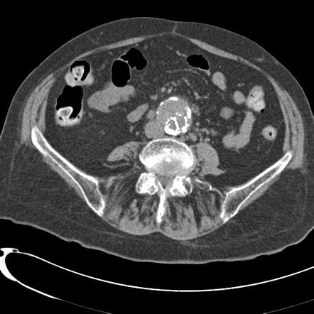 Endoleak: type Ia | Radiology Case | Radiopaedia.org