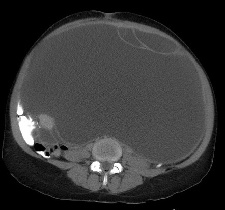 Ovarian Mucinous Cystadenoma | Image | Radiopaedia.org