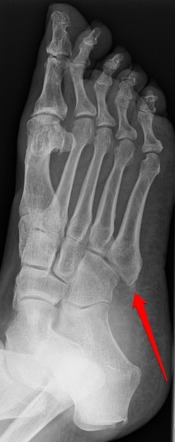 Jones fracture | Radiology Reference Article | Radiopaedia.org