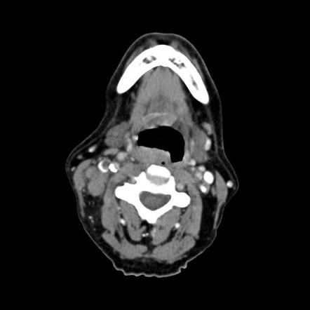 Oropharyngeal squamous cell carcinoma | Radiology Reference Article ...