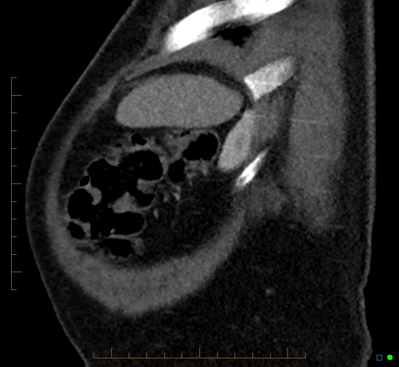 Right loin incisional hernia containing liver | Image | Radiopaedia.org