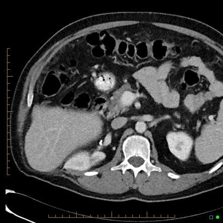 Right loin incisional hernia containing liver | Radiology Case ...