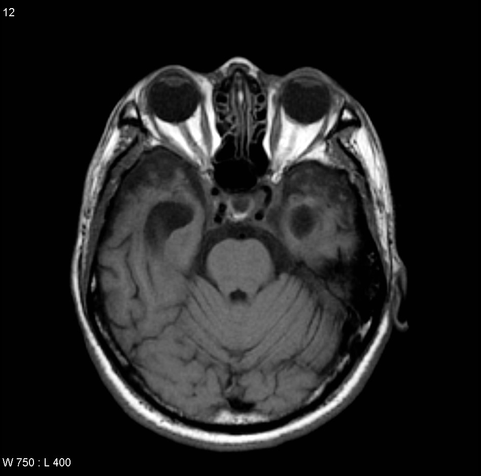 Nasopharyngeal Carcinoma Radiology Case Radiopaediaorg