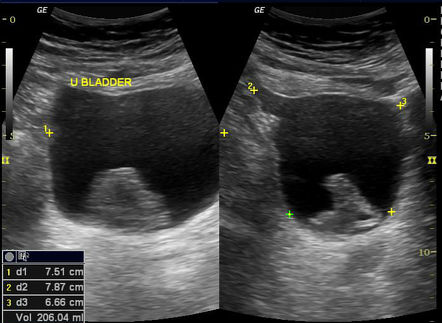 Transitional cell carcinoma of the bladder | Radiology Case ...