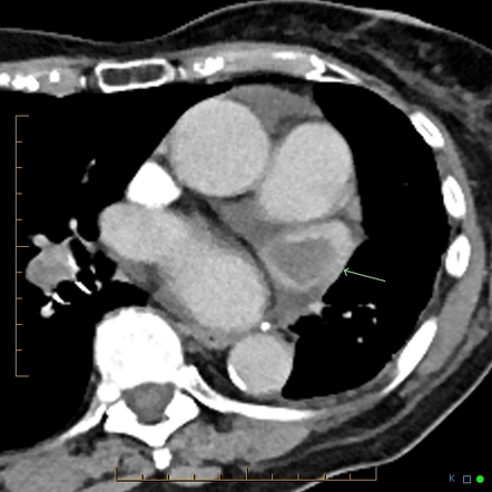 Intracardiac thrombus | Radiology Reference Article | Radiopaedia.org