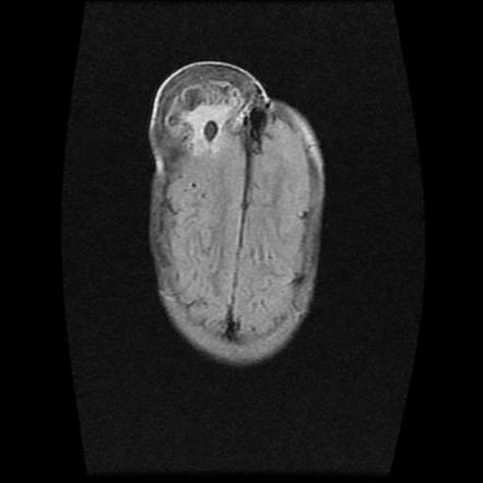 Frontal encephalocele | Radiology Case | Radiopaedia.org