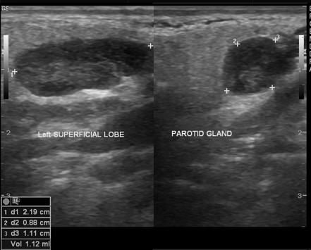 Warthin tumor | Radiology Case | Radiopaedia.org