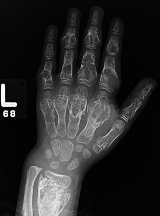 Enchondromatosis | Radiology Reference Article | Radiopaedia.org