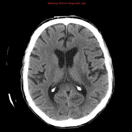 Cerebral tuberculomas | Radiology Case | Radiopaedia.org