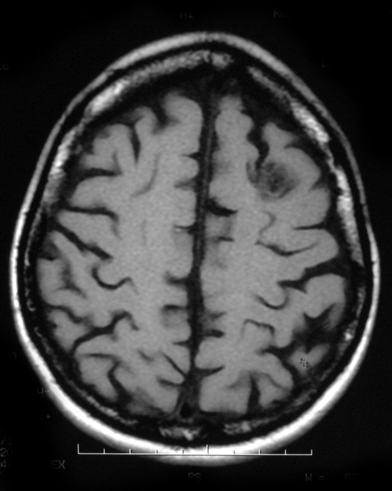 Dysembryoplastic neuroepithelial tumor (DNET) | Image | Radiopaedia.org