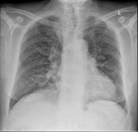 Multiple myeloma | Image | Radiopaedia.org