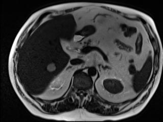 Hepatic Hemangioma Atypical On Ultrasound Hepatic Steatosis Image