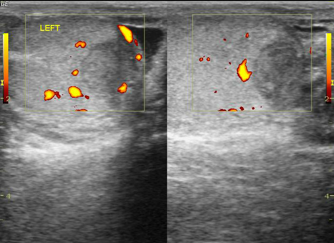 Testicular hematoma | Image | Radiopaedia.org