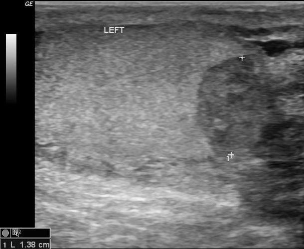 Testicular hematoma | Image | Radiopaedia.org