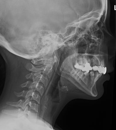 Subcutaneous emphysema complicating a tooth extraction | Radiology Case ...