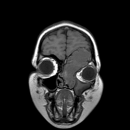 Paranasal sinus mucocele | Radiology Reference Article | Radiopaedia.org