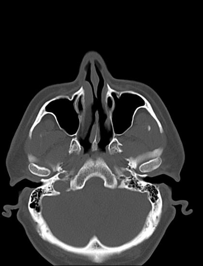 Nasal septal perforation | Image | Radiopaedia.org