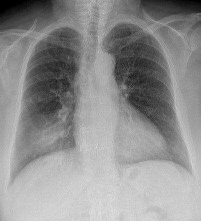 Consolidation Chest X Ray