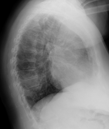 Right lower lobe consolidation - pneumonia | Image | Radiopaedia.org