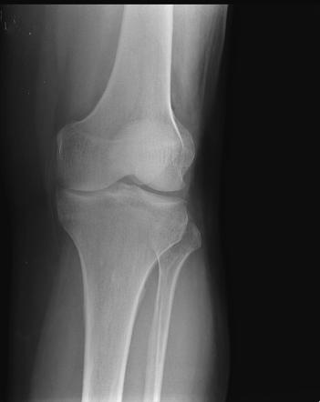 Slow flow vascular malformation - knee | Radiology Case | Radiopaedia.org