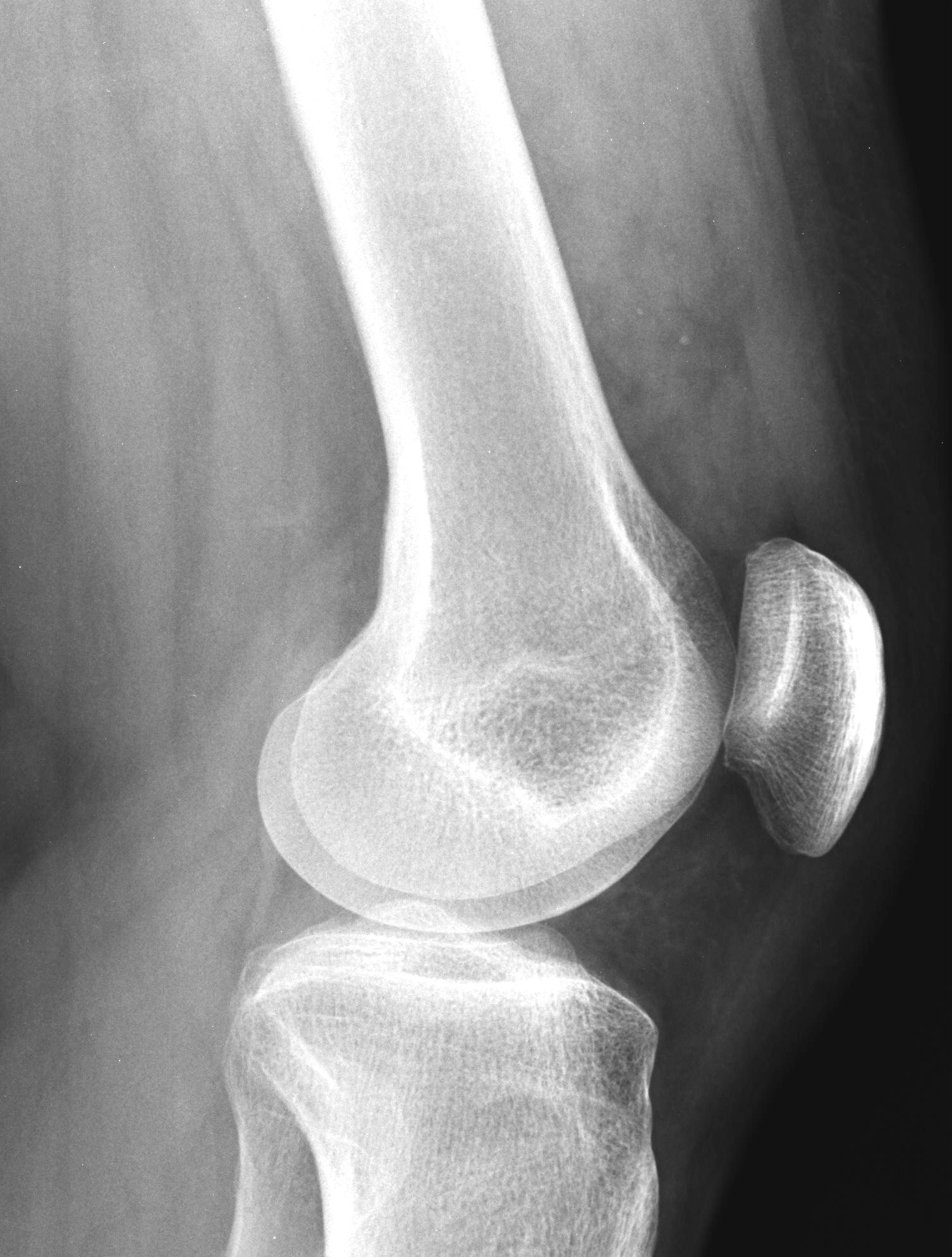 Slow flow vascular malformation - knee | Image | Radiopaedia.org