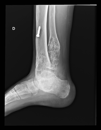 Maffucci syndrome | Image | Radiopaedia.org