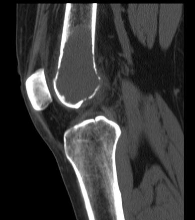 Giant cell tumor - femur | Image | Radiopaedia.org