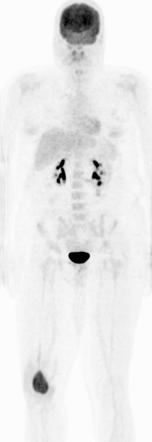 Giant cell tumor - femur | Radiology Case | Radiopaedia.org