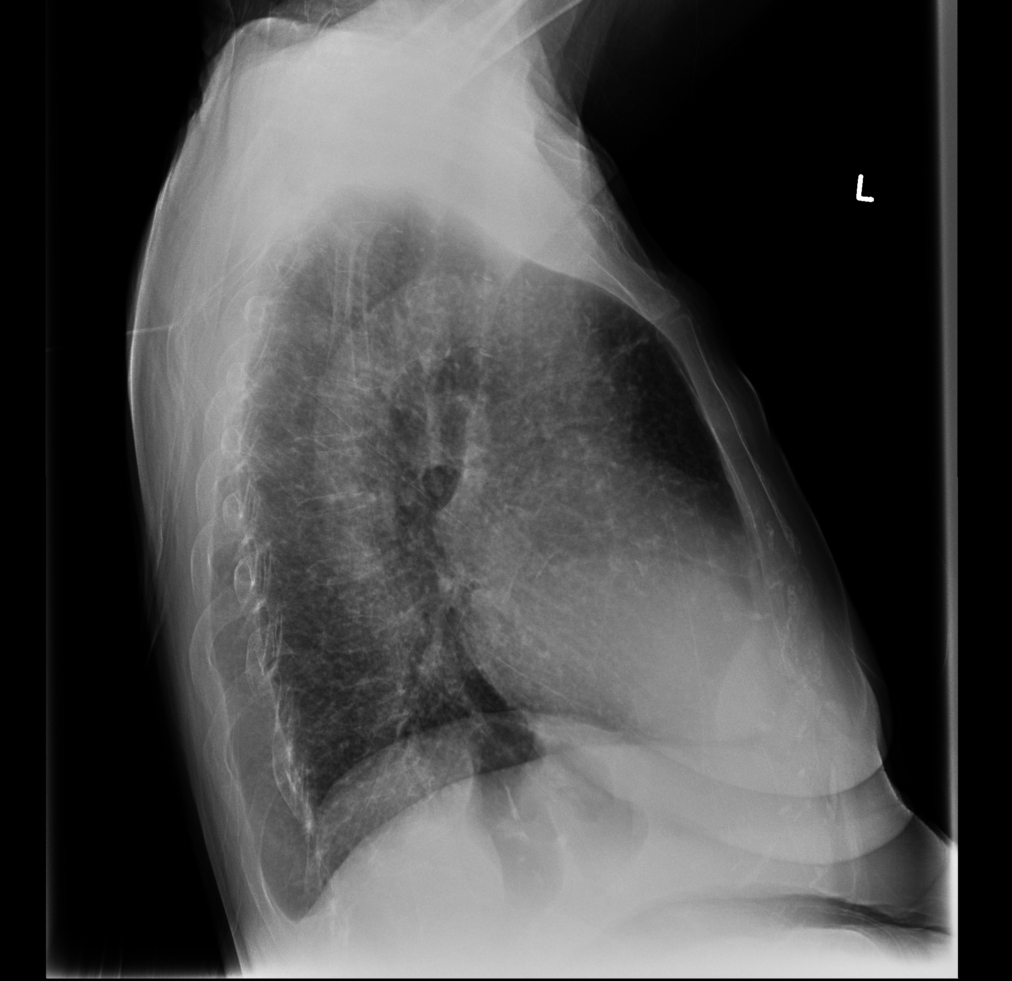 Miliary nodules - exam approach | Image | Radiopaedia.org