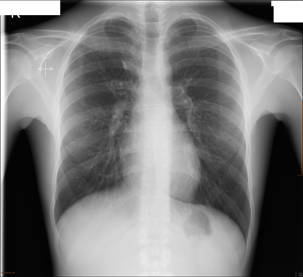 Azygos lobe | Radiology Case | Radiopaedia.org