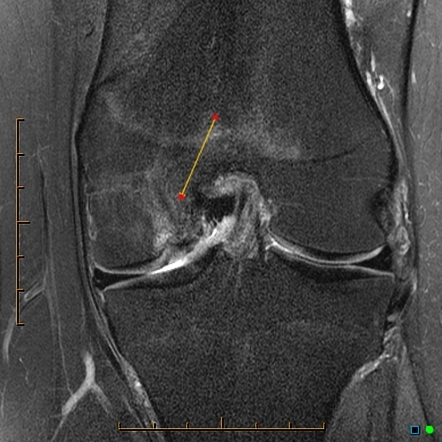 Repaired osteochondritis dissecans of the knee | Radiology Case ...