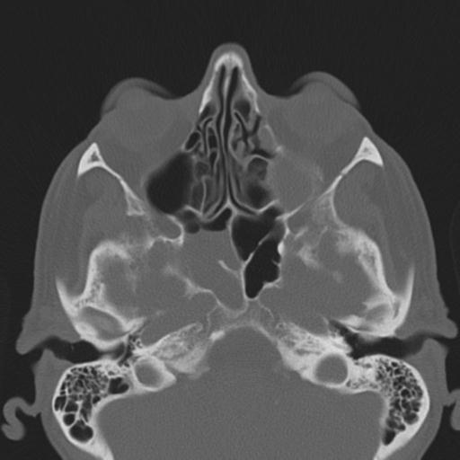 Sphenoid encephalocoele | Image | Radiopaedia.org