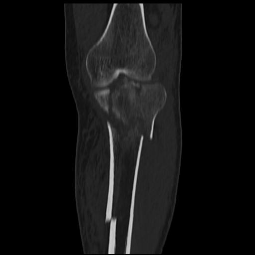 Tibial Plateau Fracture Schatzker Type Vi With Lipohemarthrosis