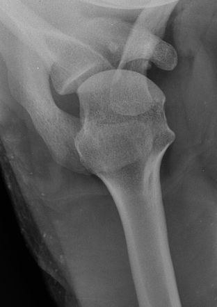 Hill-Sachs defect | Radiology Reference Article | Radiopaedia.org