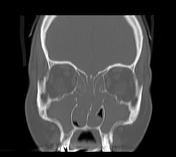 Sinonasal polyposis | Radiology Reference Article | Radiopaedia.org