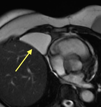 Pericardial cyst | Radiology Case | Radiopaedia.org