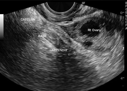 Pelvic appendix (transvaginal scan) | Radiology Case | Radiopaedia.org