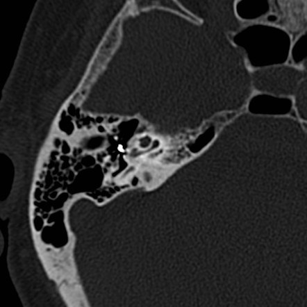 Stapes, Radiology Reference Article