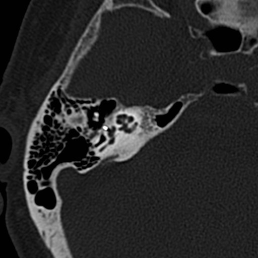 Otosclerosis And Stapes Prosthesis Image