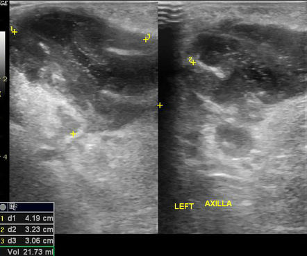 icd 10 codes for axillary abscess