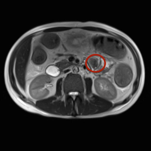 Ectopic pancreatic tissue | Image | Radiopaedia.org