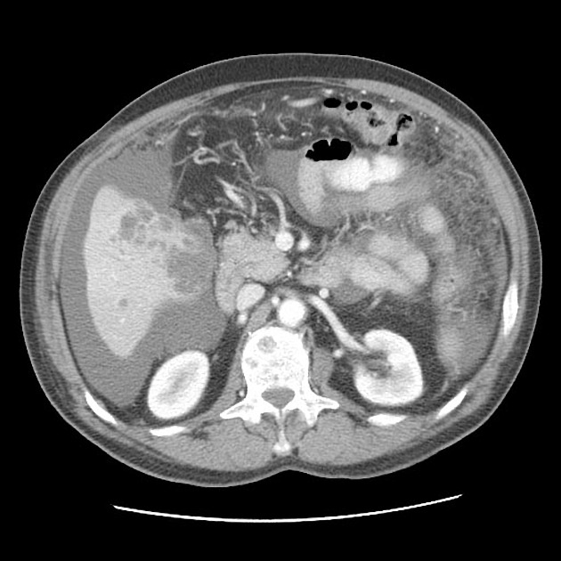 how long do ovarian biopsy results take