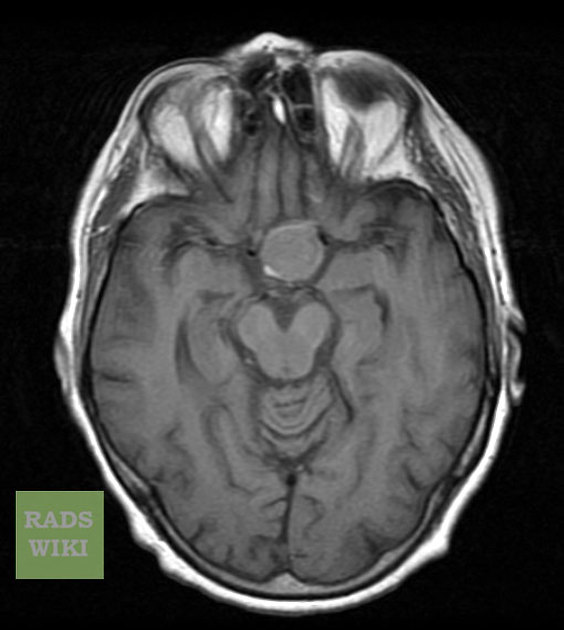 Pituitary Adenoma Mri