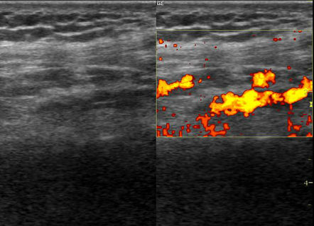 Slow flow vascular malformation - knee | Image | Radiopaedia.org